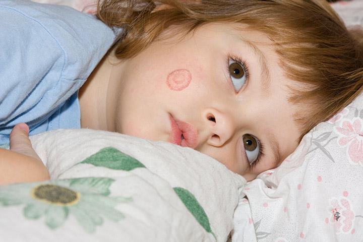 How to Treat Ringworm in Children: A Comprehensive Guide - 4aKid