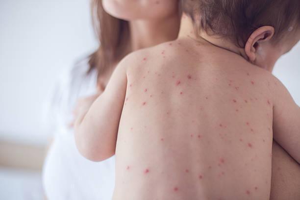 What Is Chickenpox? - 4aKid